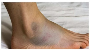 Skin Signals: 7 Unexpected Signs of Heart Disease You Should Know