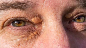 Skin Deep: Warning Signs of High Cholesterol You Can See