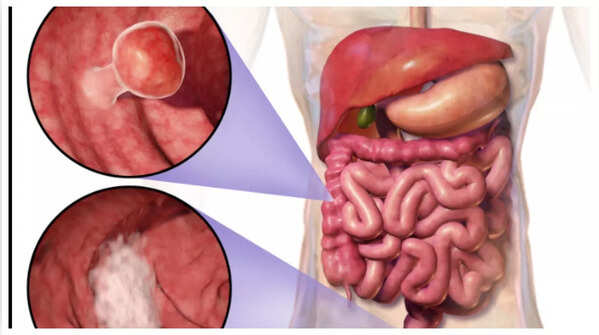 Blood present in stool.