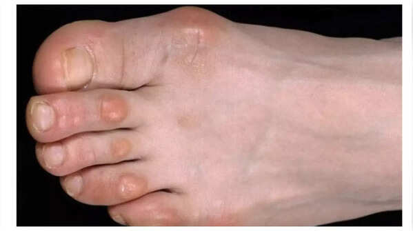 Painful nodules on fingers linked to heart problems