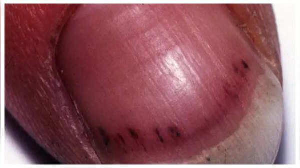Splinter hemorrhages indicating potential heart infection