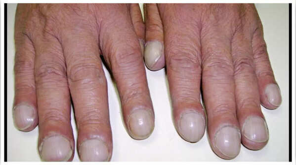 Curved nails as a sign of low oxygen levels