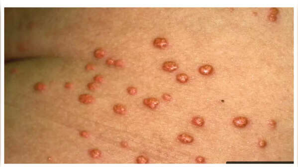 Yellow bumps around the eyes related to cholesterol