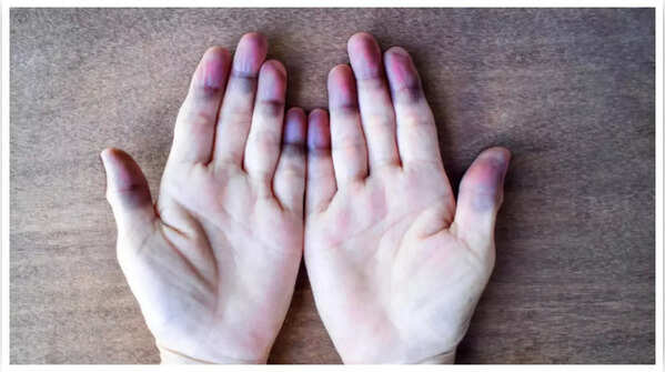 Blue toes, a possible sign of poor circulation